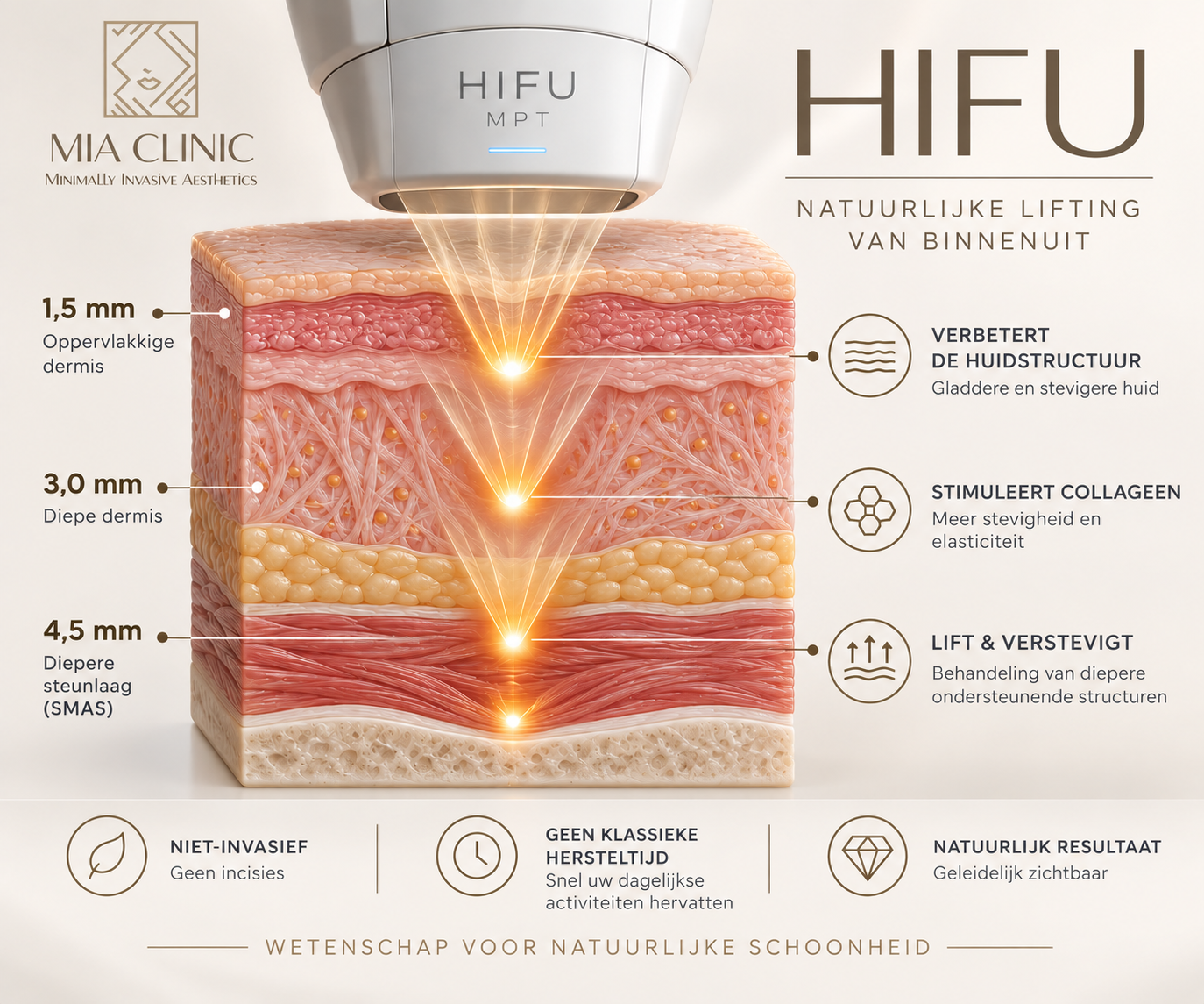 Hifu MIA CLINIC huidlagen IFU MPT behandeldieptes voor huidverstrakking